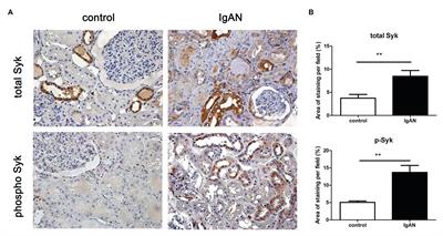 Spleen Tyrosine Kinase Inhibition Ameliorates Tubular Inflammation in IgA Nephropathy